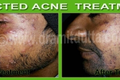 Acne-Vulgaris-ayurvedic-skin-treatment