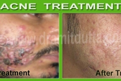 Acne-Vulgaris-ayurvedic-skin-treatment_2