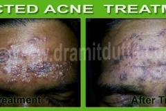 Acne-Vulgaris-ayurvedic-skin-treatment_3