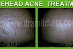 Acne-Vulgaris-ayurvedic-skin-treatment_4