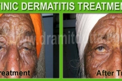 Actinic-Dermatitis-ayurvedic-skin-treatment