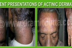 Actinic-Dermatitis-ayurvedic-skin-treatment_2