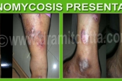Actinomycosis-ayurvedic-skin-treatment