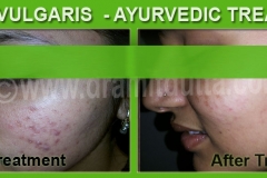 acne-treatment-new