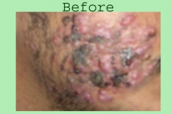 acne_before